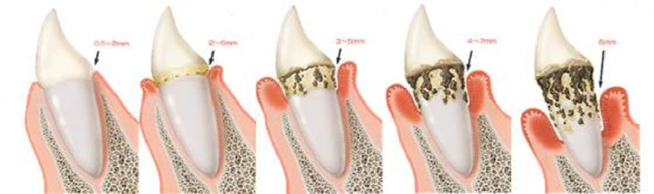 UTILIZAREA ULTRASUNETELOR IN TERAPIA ENDODONTICA